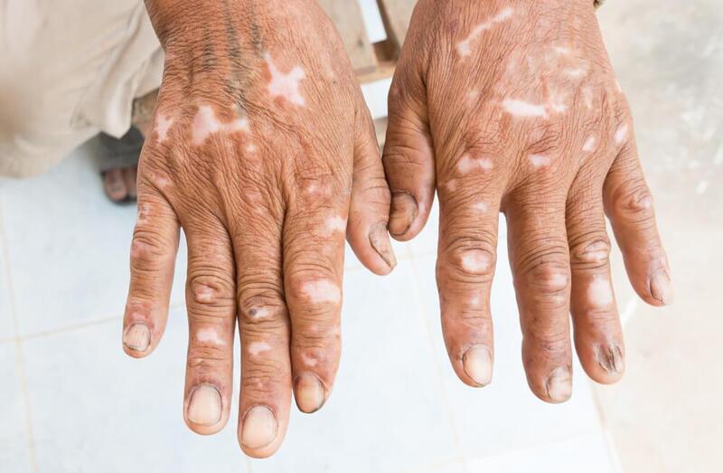 esclerodermia maos