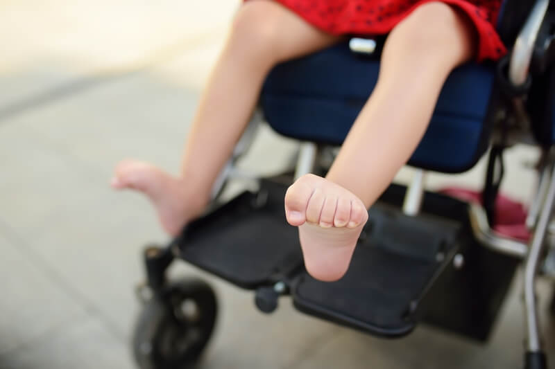 sindrome de dravet crianca