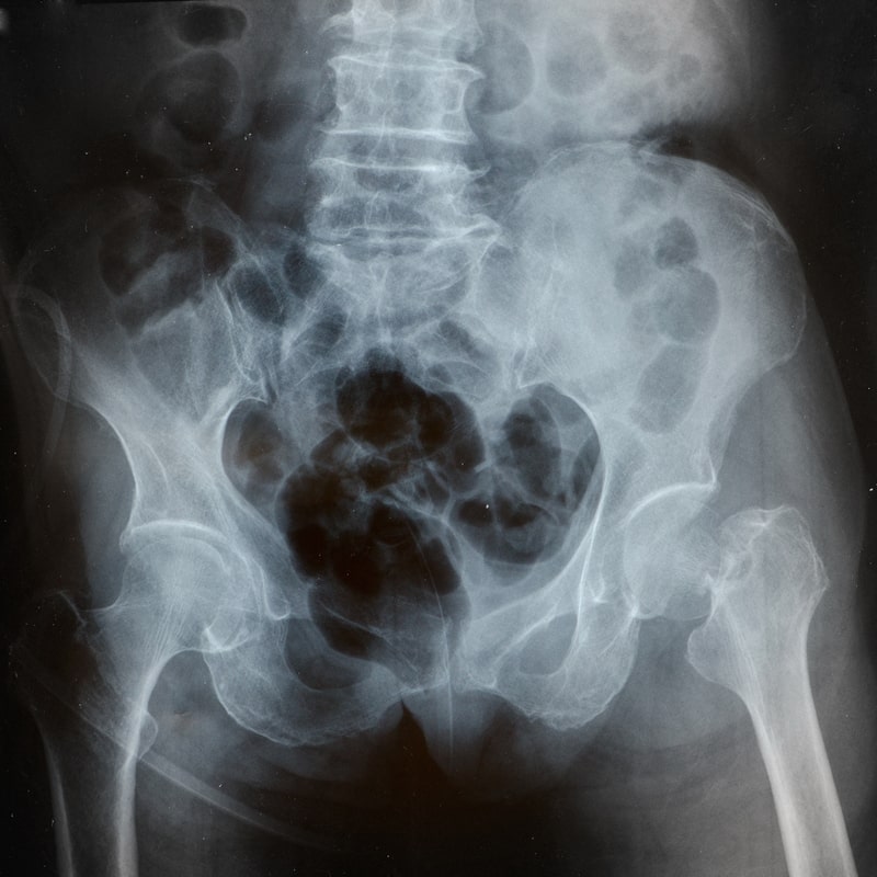 remedio para osteoporose raio x