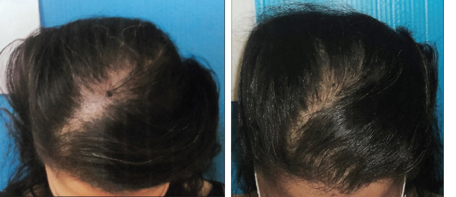 Imagem mostra antes e depois do tratamento para alopecia com CBD. Crescimento capilar notório na foto à esquerda