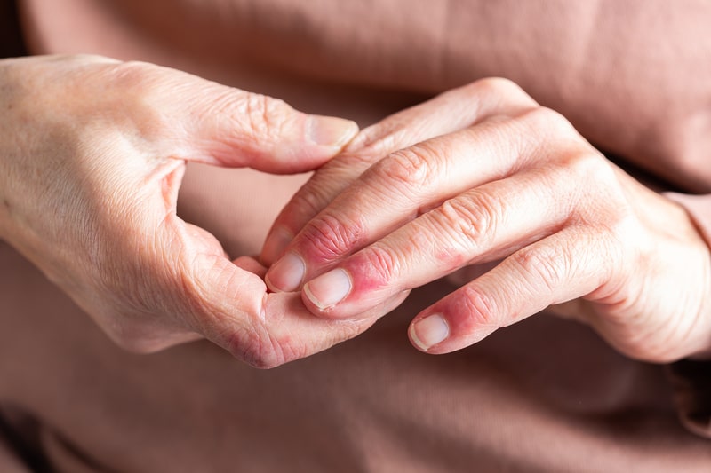 eczema tratamento maos feridas