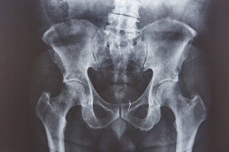 sindrome da dor pelvica cronica raio x