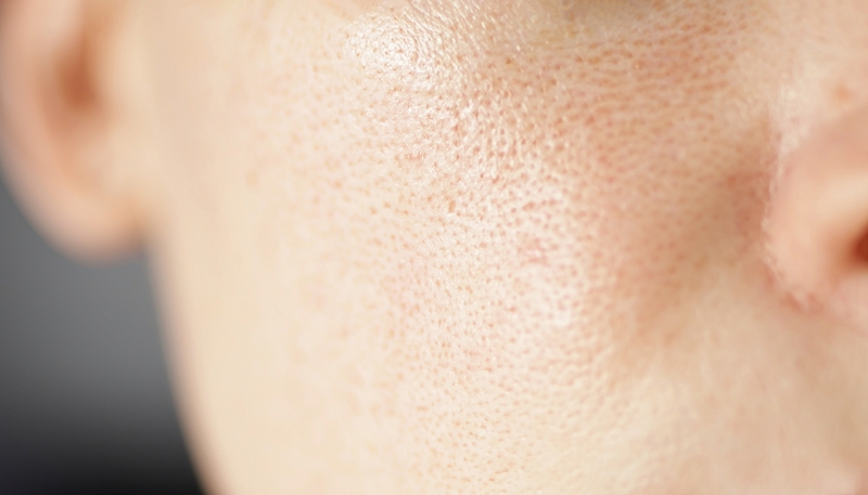 tratamento para rosacea severa
