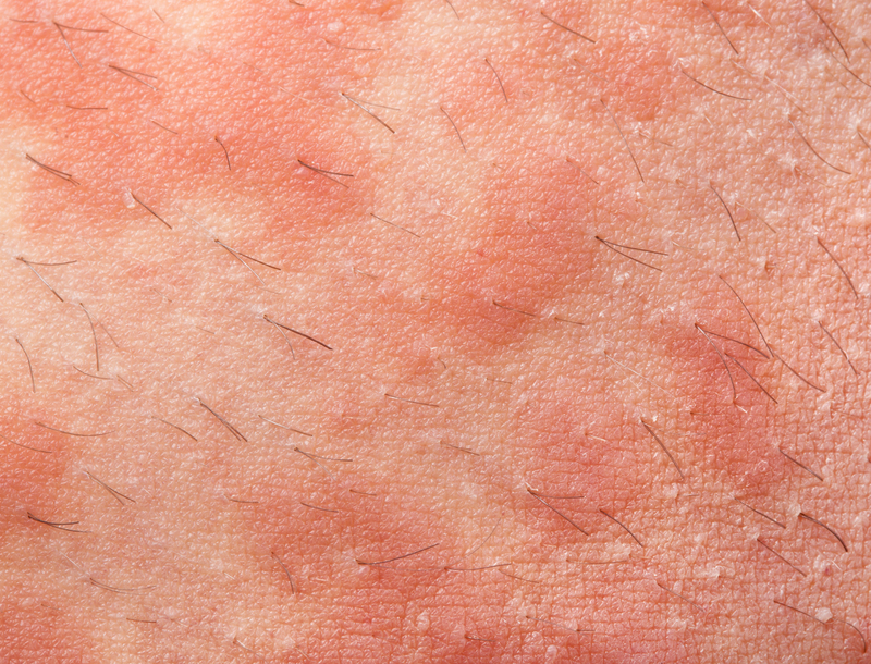 tratamento da erisipela com antibioticos