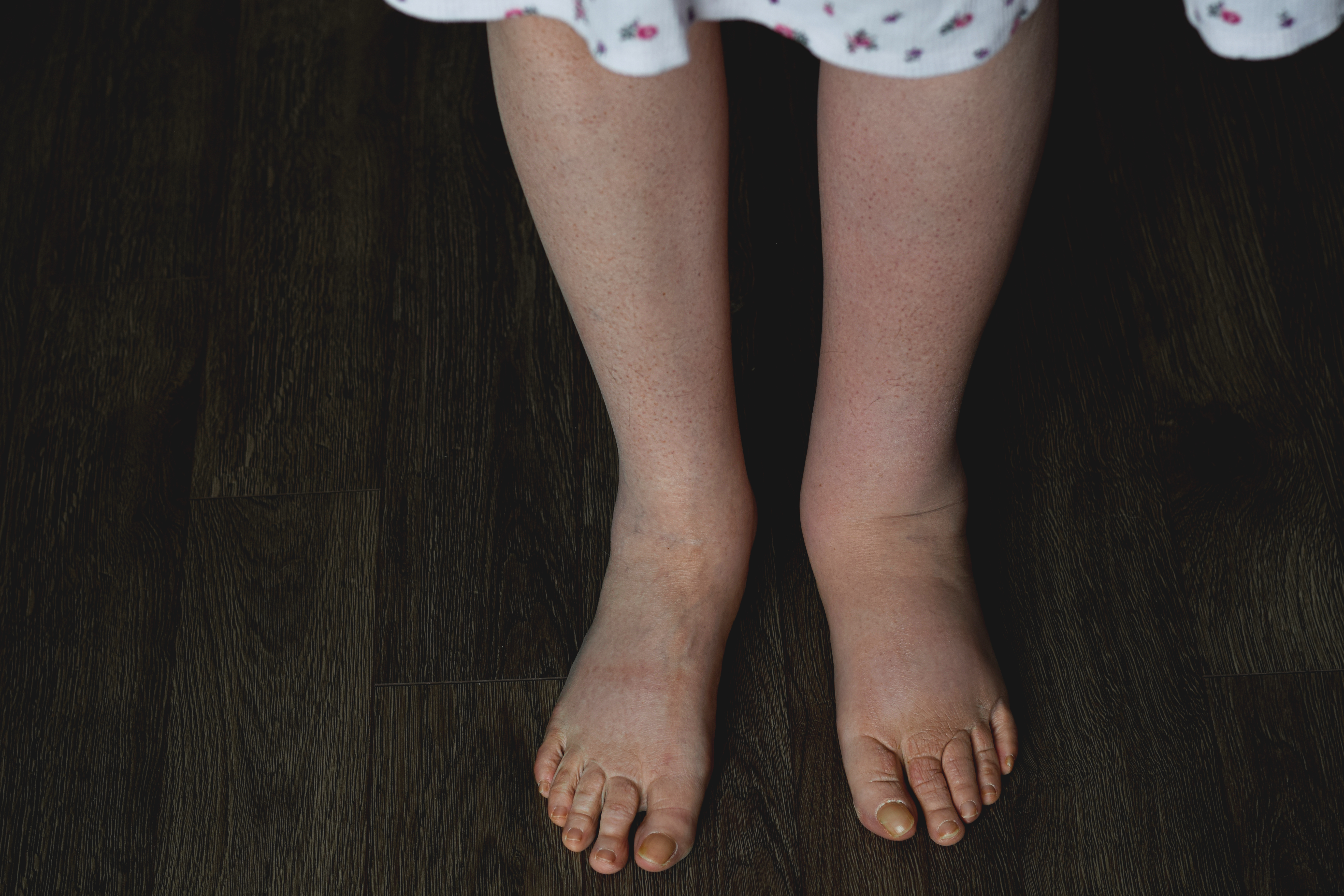 Linfedema: pesquisa combina CBD e cúrcuma no tratamento