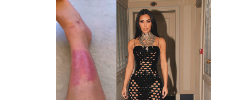 Cannabis ajudaria a Kim Kardashian a tratar psoríase?