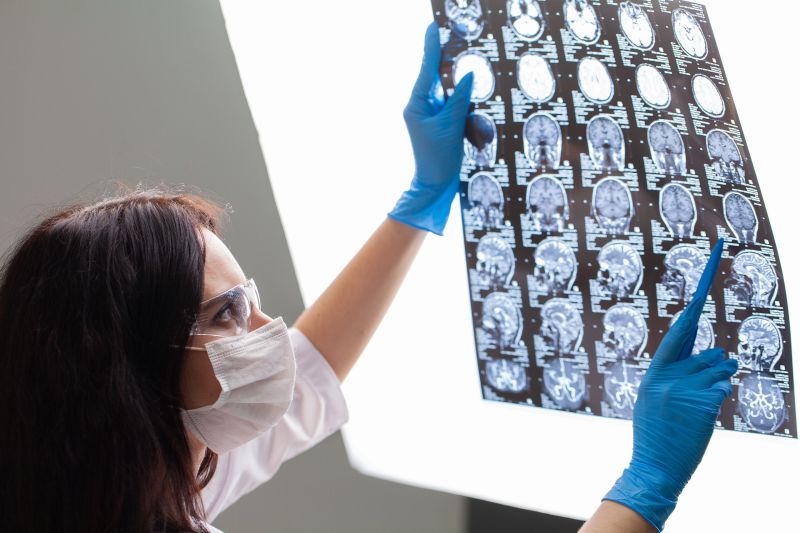 a epilepsia e a evolução do uso de Cannabis medicinal