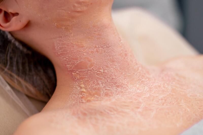 pomada com canabinoides para dermite alergia