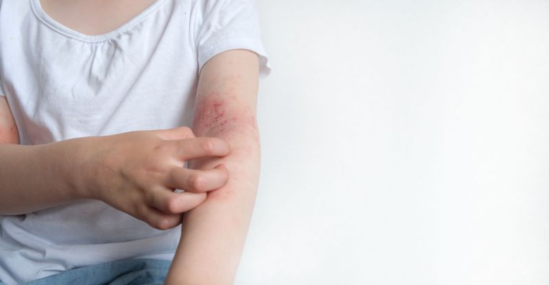 Canabigerol na pele: uma nova possibilidade contra a dermatite atópica