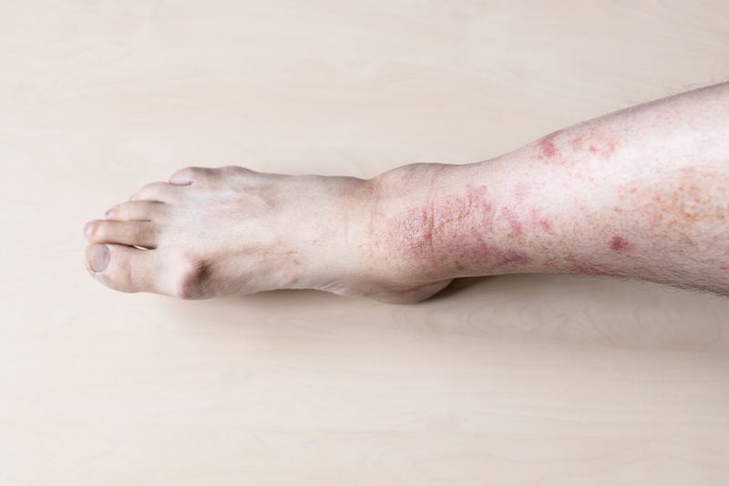 tratamento da erisipela com cbd